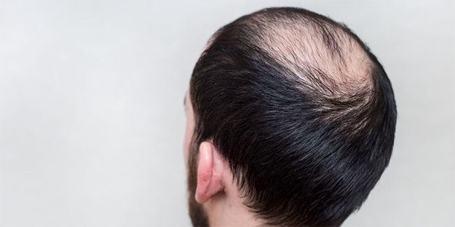 Khám phá các loại thuốc mọc tóc trị rụng tóc tốt nhất hiệu quả nhất hiện  nay 22023